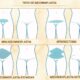 Tipos de abdominoplastia